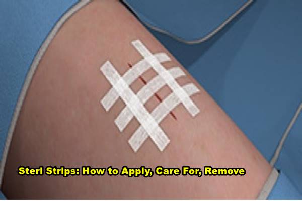 Steri Strips: How to Apply, Care For, Remove